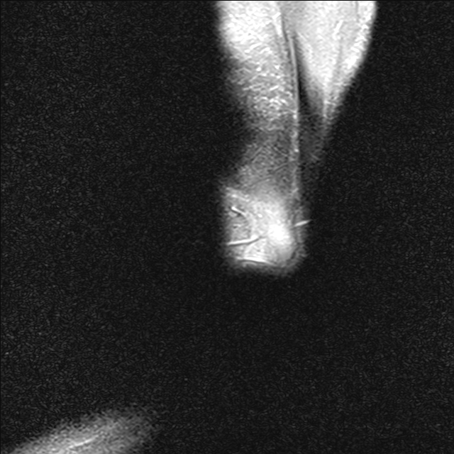 tacy  MRI  2