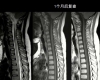 MRI4853：三博Ⅻ-05，男性，10岁。发热、肢体无力4天……