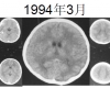 MRI4135：三博Ⅹ-13，女性，26岁，发作性全身抽搐18年。