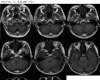 MRI6573：三博23-18，男性，36岁。头晕4月。