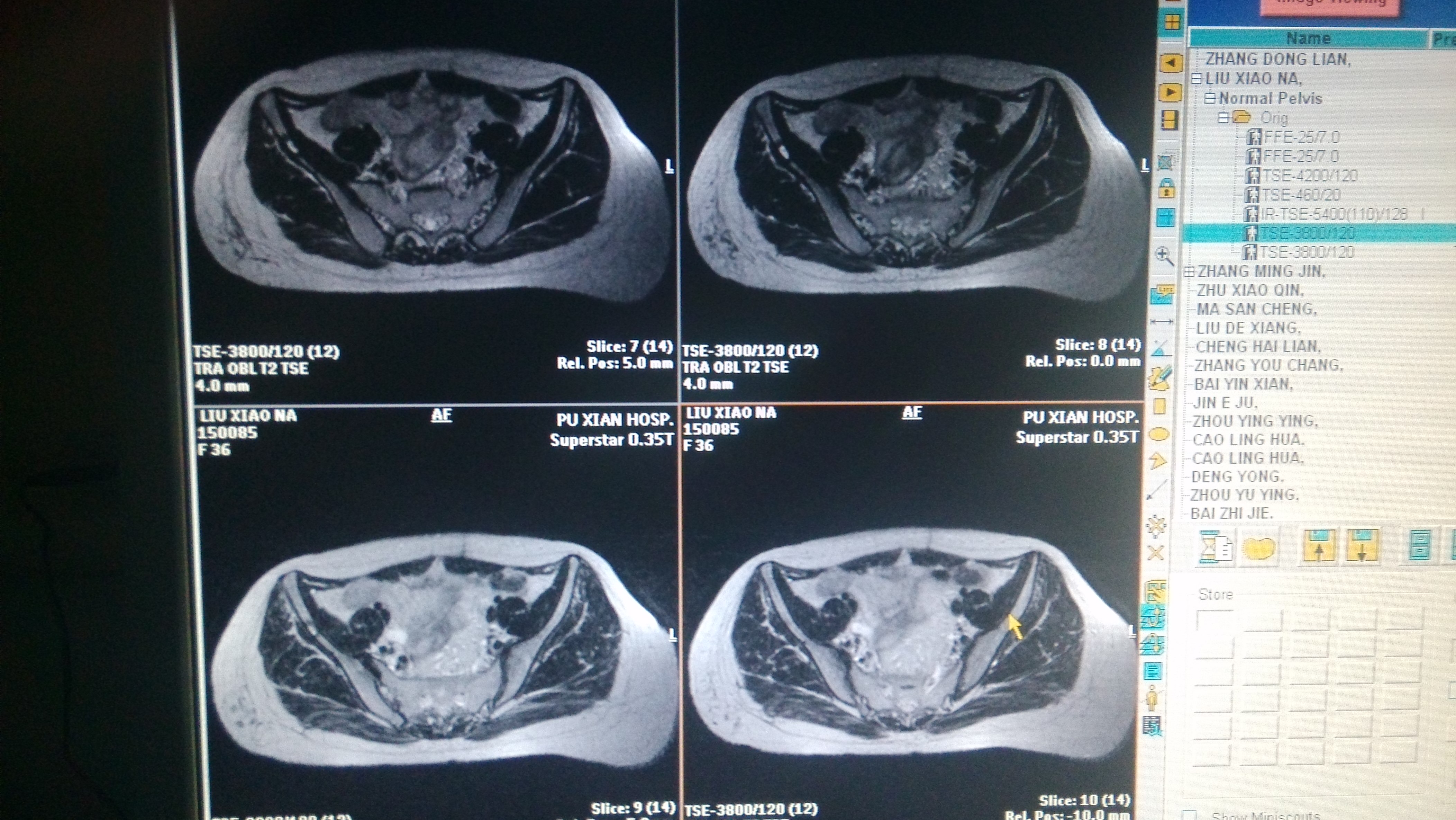 mri6567:骨盆