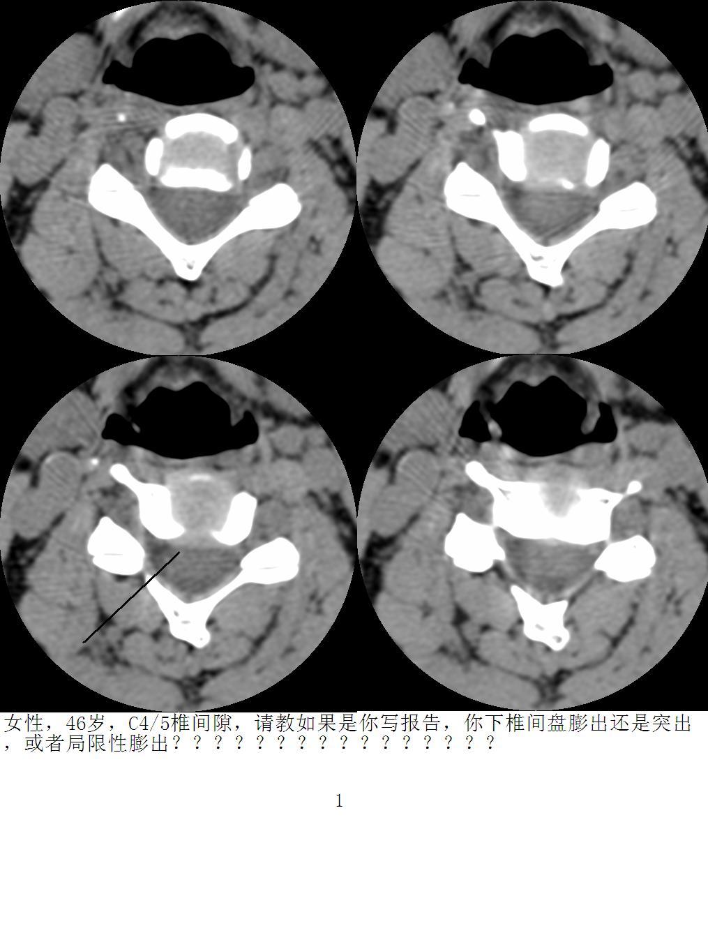 ct49985:请教,颈椎间盘是否有膨出的诊断?