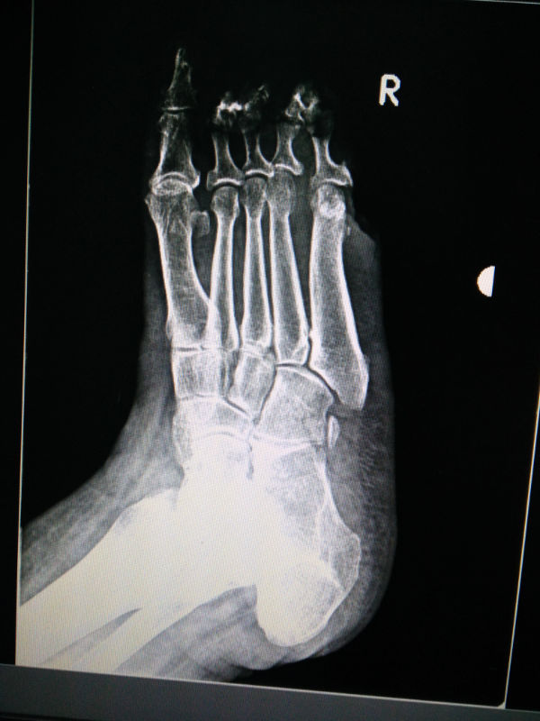 x13673:右足正斜位,骨髓炎?