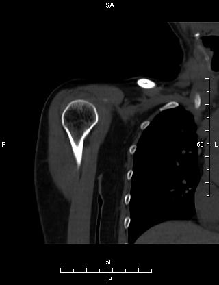 ct50103:右肩关节ct