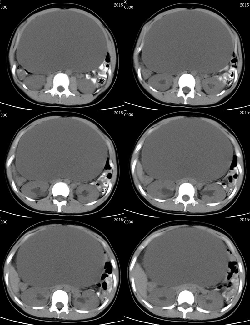 ct50301:女性,22岁.腹部膨隆胀满,伴纳差1月