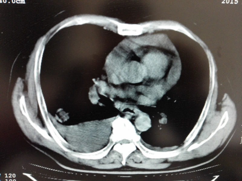 ct50308:肺占位?胸腔积液!心包积液!