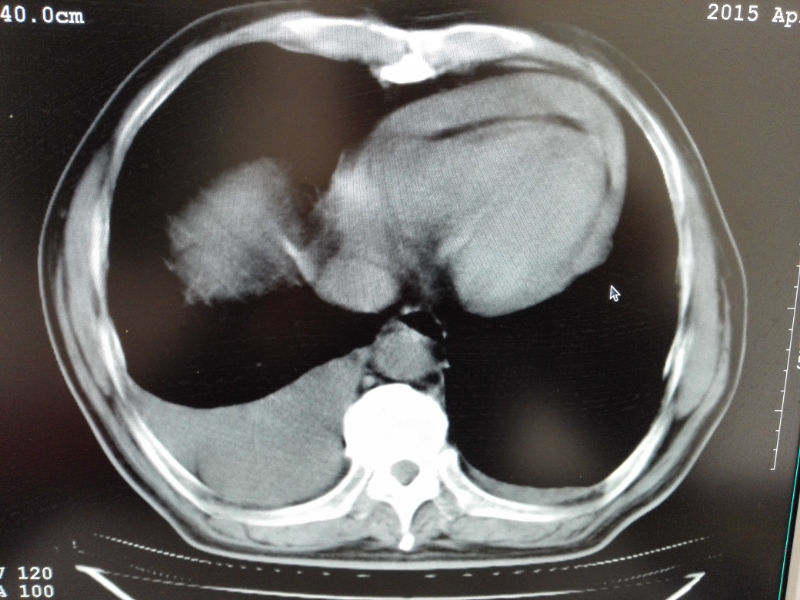 ct50308肺占位胸腔积液心包积液