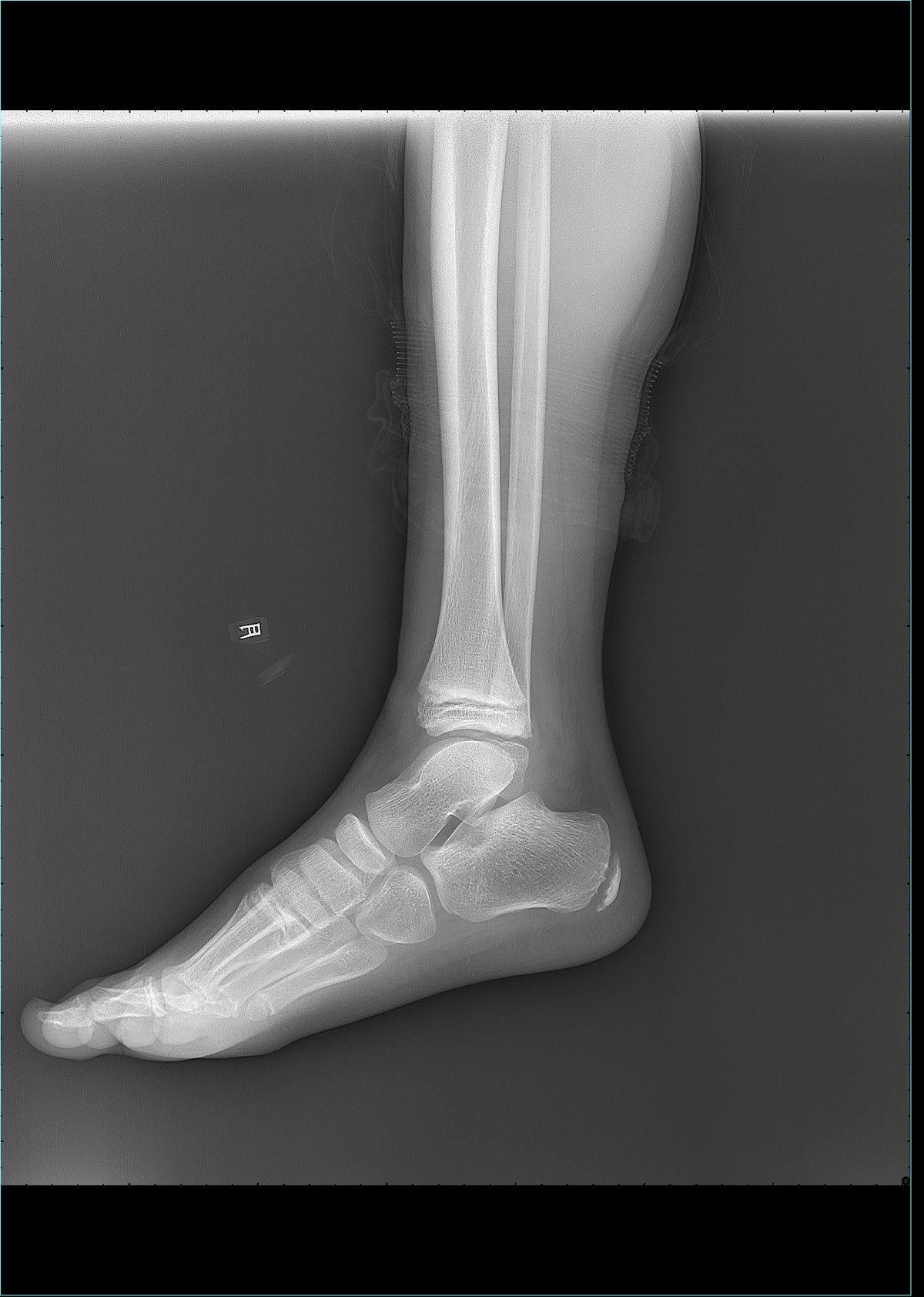 x13707:m-8,右侧踝关节外伤后疼痛半小时余 x线病例讨论 医影在线