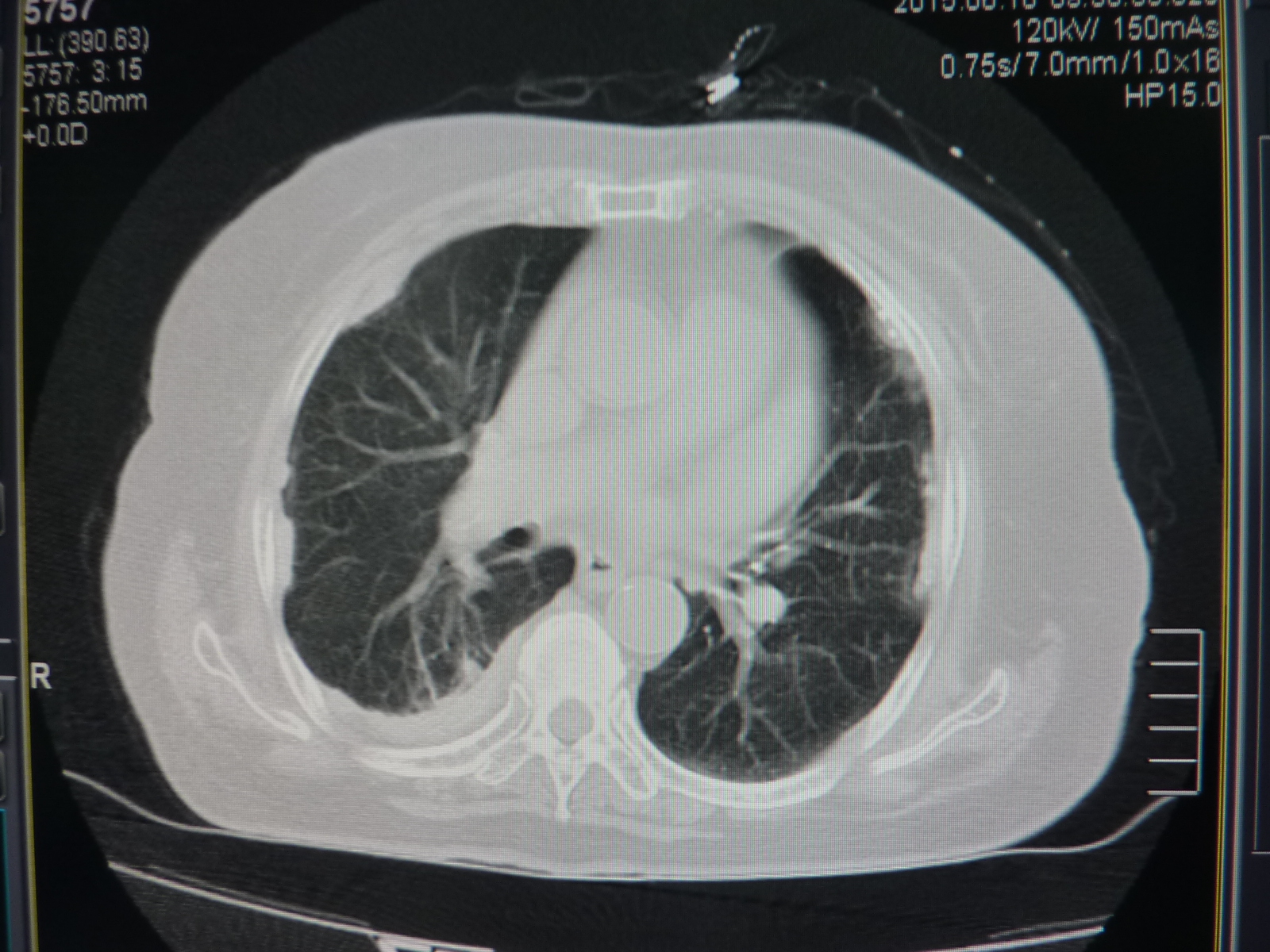 ct50694:右乳腺癌保乳术后七年,胸痛,呼吸困难