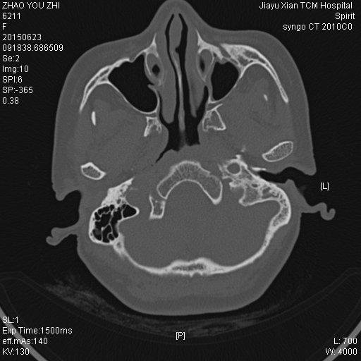 ct50731:女,40y,乳突