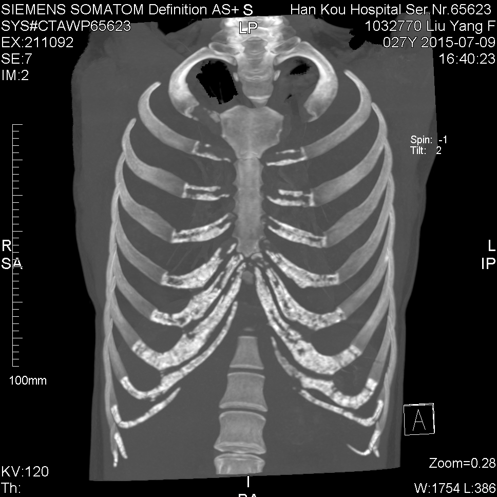ct50824:女27岁,双侧肋软骨广泛骨化