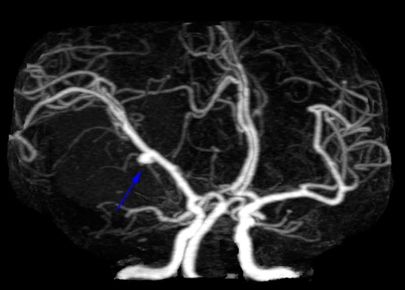 cl2892:脑动脉瘤10:大脑中动脉动脉瘤
