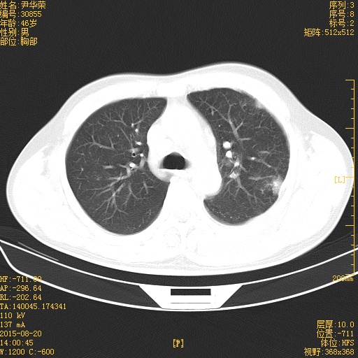 ct51066:这左上肺是考虑胸膜间皮瘤还是周围性肺ca