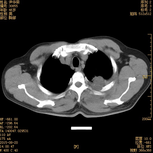ct51066:这左上肺是考虑胸膜间皮瘤还是周围性肺ca