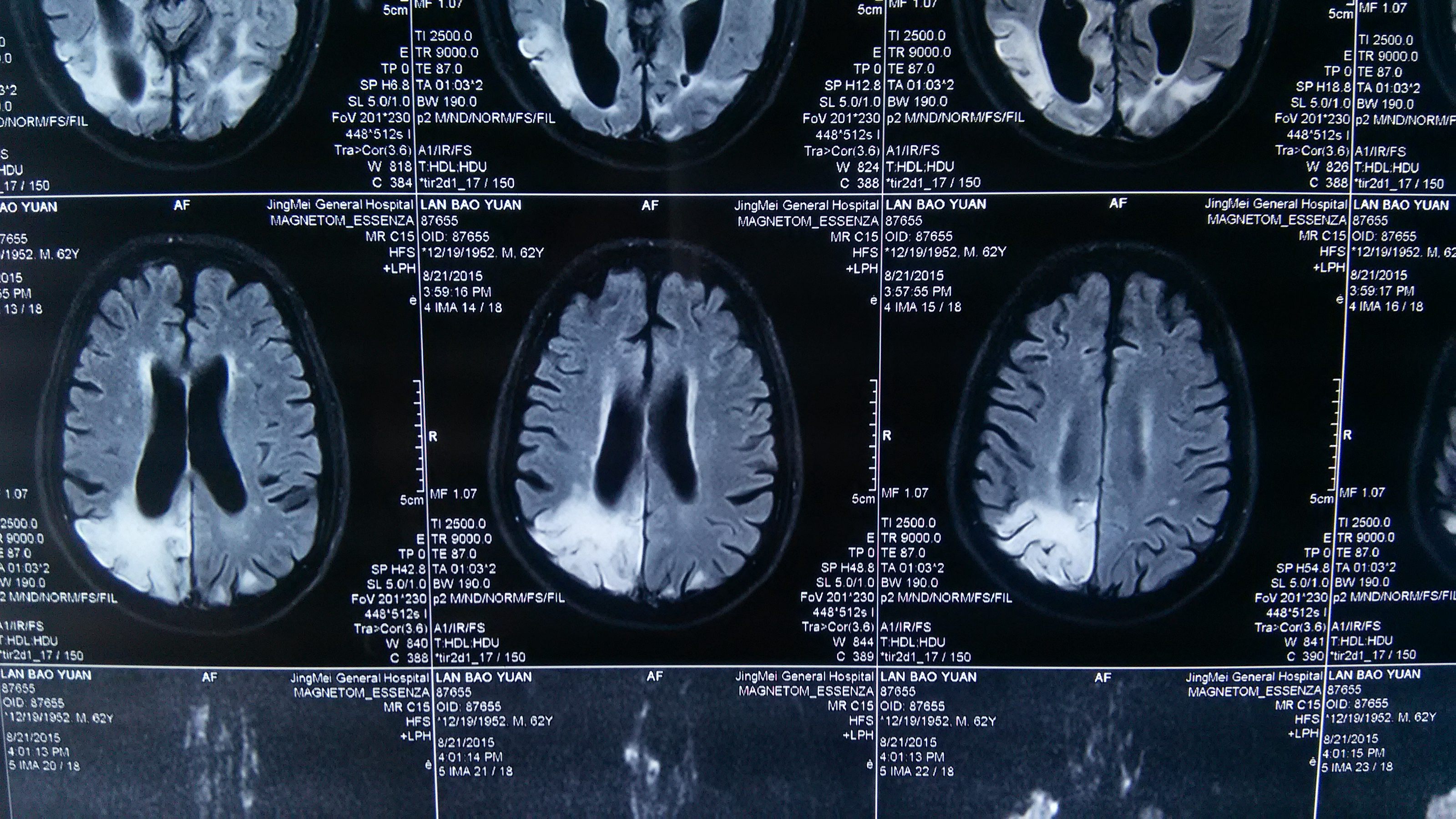 mri6755老年患者10年前左侧枕叶曾经得过脑脓肿