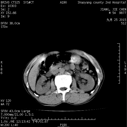 [腹盆腰部 ct51164:看看是结石还是静脉石