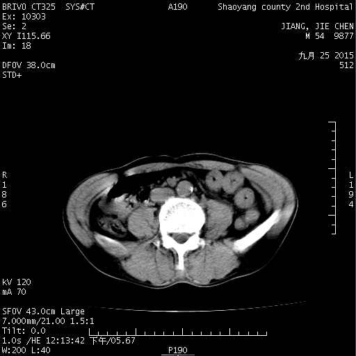 [腹盆腰部] ct51164:看看是结石还是静脉石
