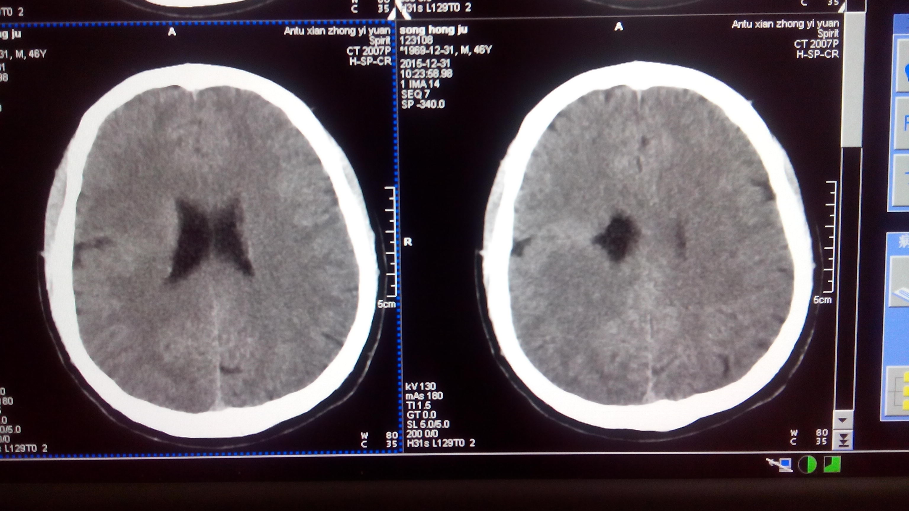 ct51479典型的脑灰质移位鉴赏之