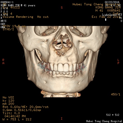 ct51610:m,41y.鼻部不适数月.