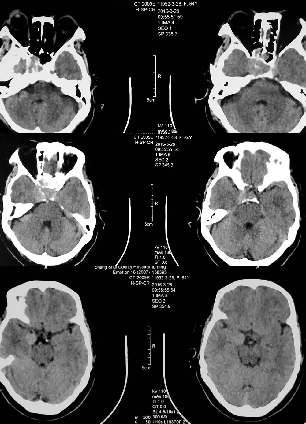 mri6949:鞍区占位,ct mr平扫,增强,请会诊!