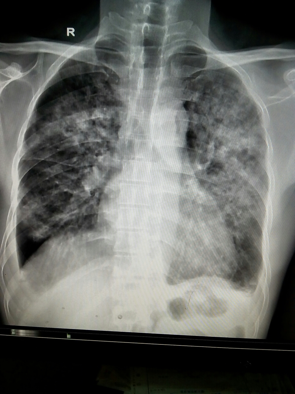 半年前某医院行胰腺囊肿切除术,出院记录拍片两肺纹理增强余无异常.