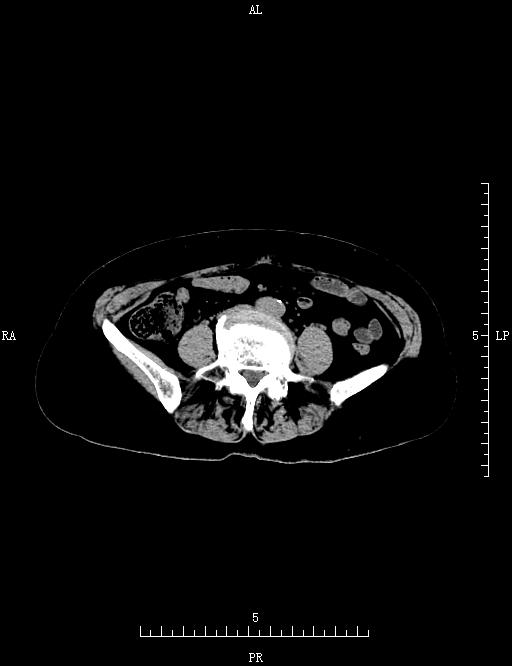 ct51899双肾输尿管膀胱ct