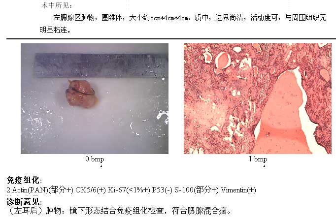 ct52058:腮腺混合瘤