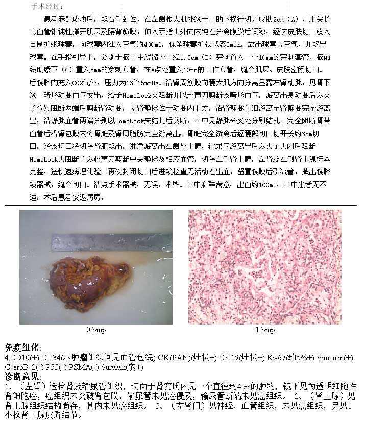 cl2934肾癌透明细胞癌