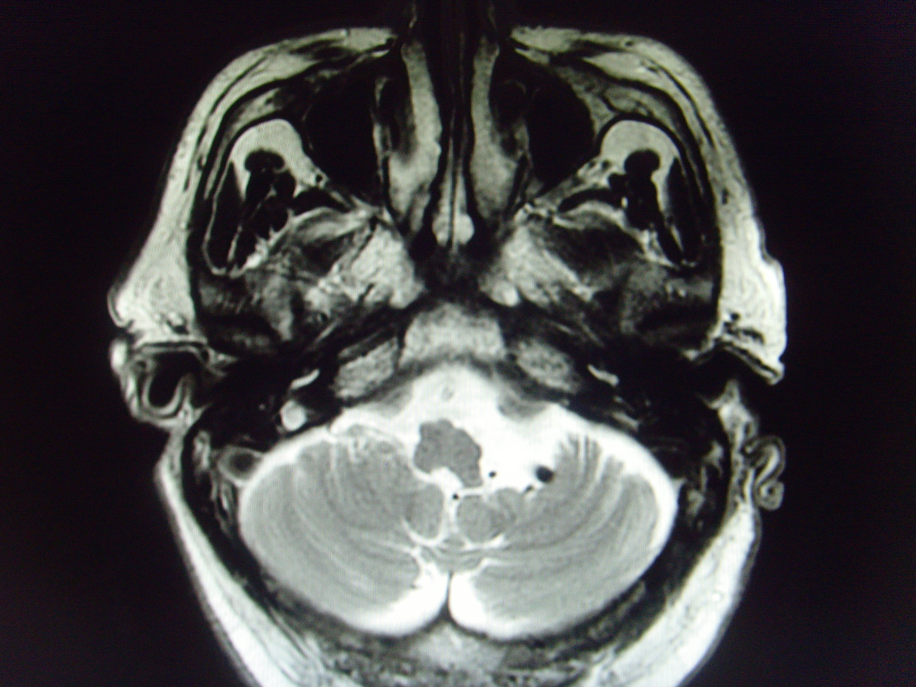 mri7135:左侧桥小脑角病变诊断什么?