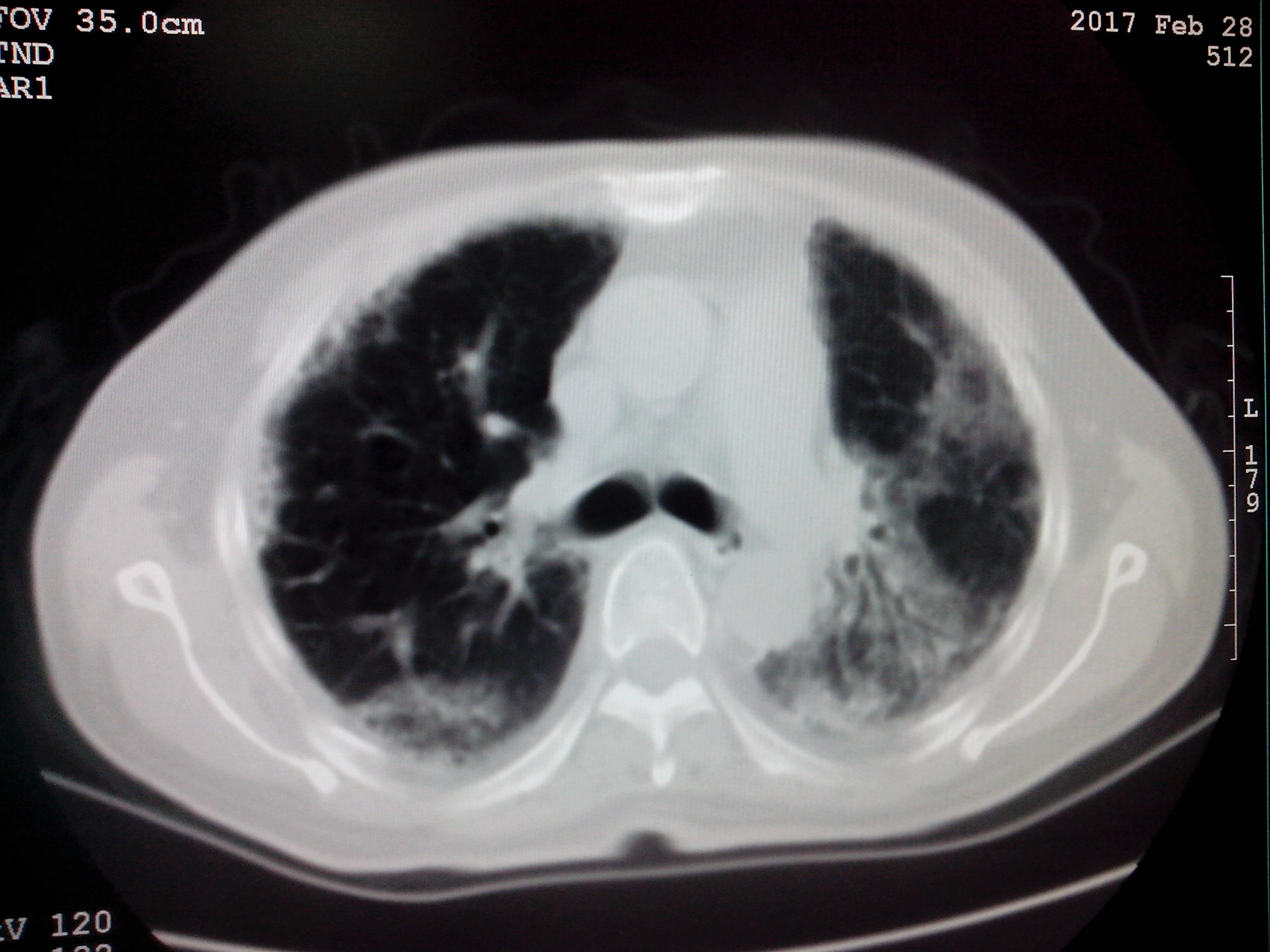 ct52646是肺纤维化吗放射性肺炎