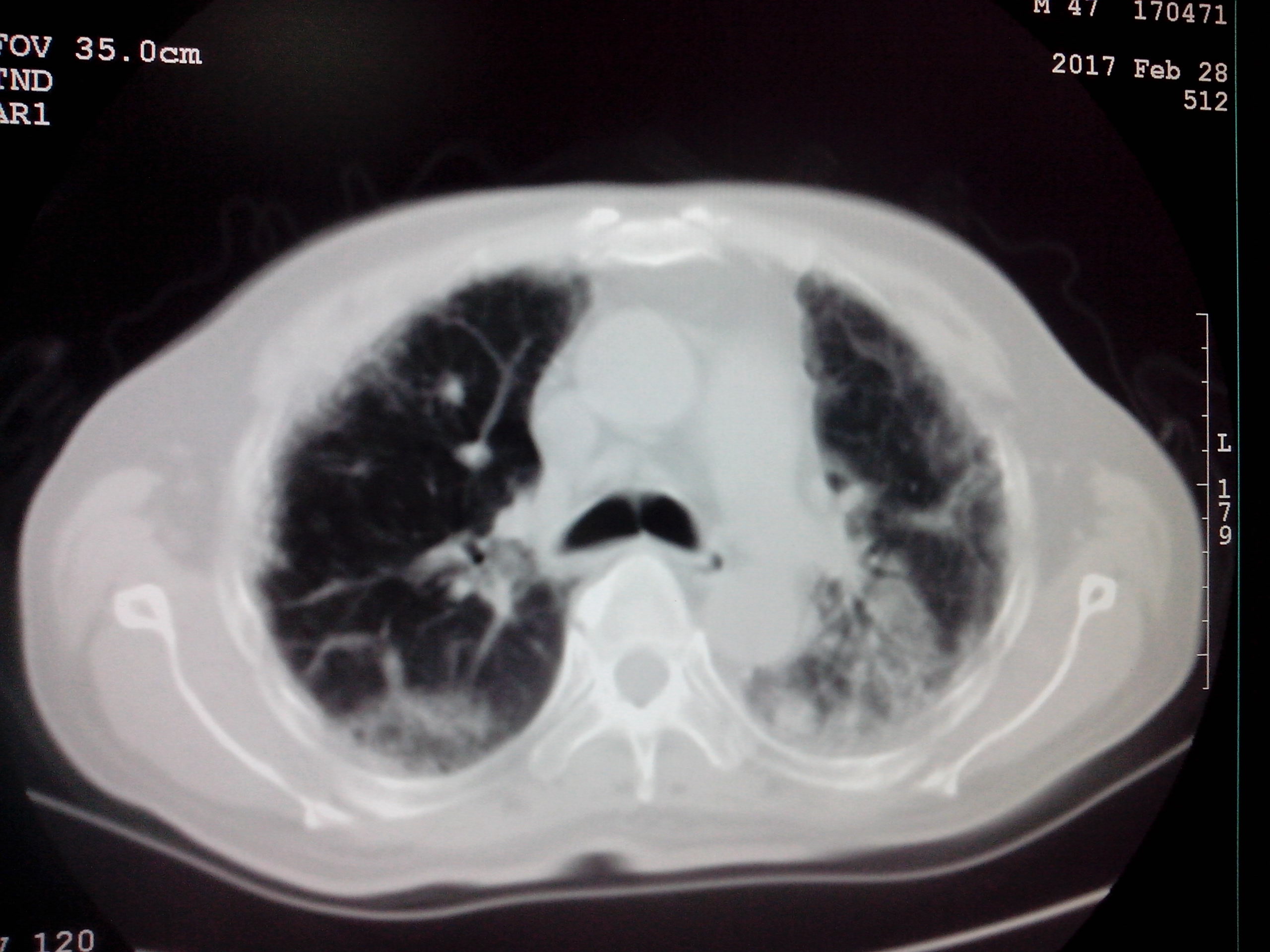 ct52646是肺纤维化吗放射性肺炎