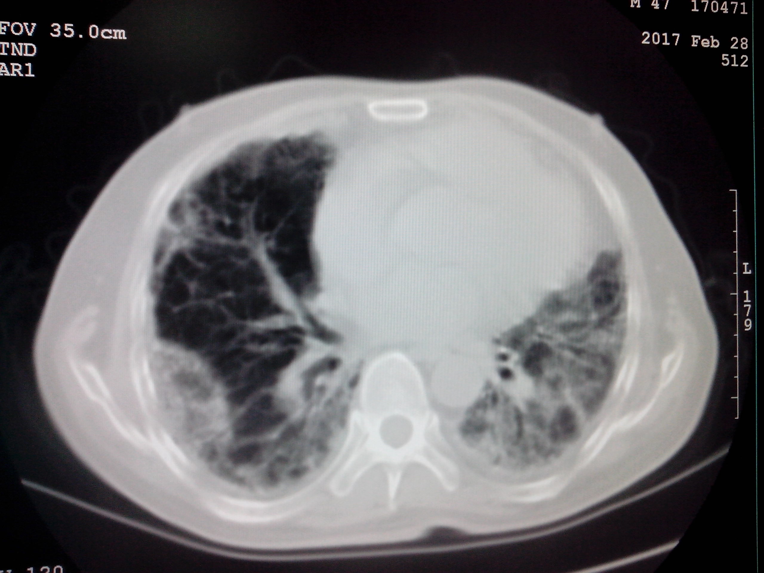 社区 69 影像读片 69 ct病例讨论 69 ct52646:是肺纤维化吗?
