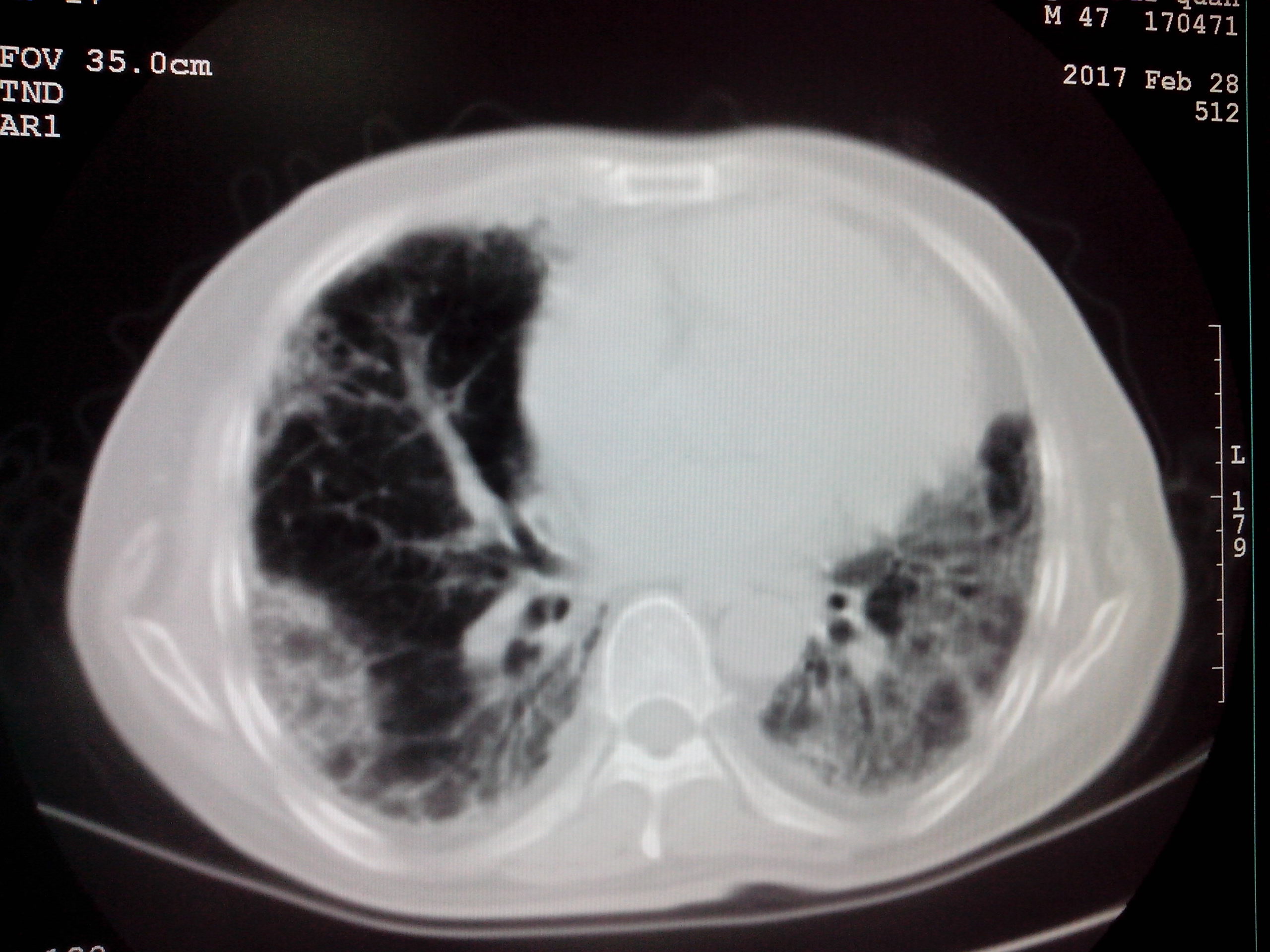 ct52646:是肺纤维化吗?放射性肺炎?