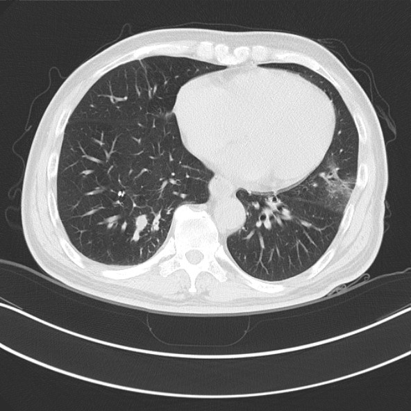 肺ca?慢性炎症?