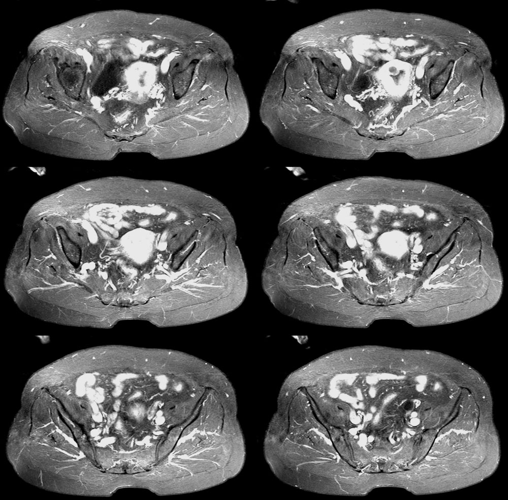 mri7181子宫占位