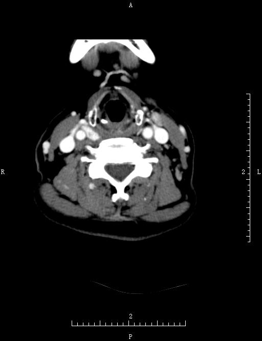 ct52910:甲状腺ct