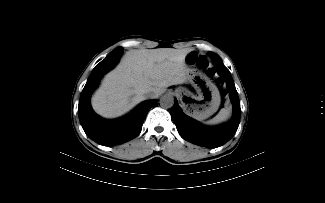 ct53060:临床考虑腹主动脉瘤