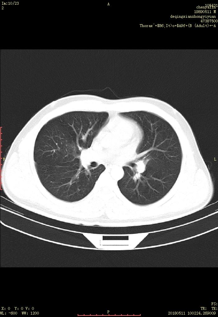 29y,体查发现右肺中叶站位.