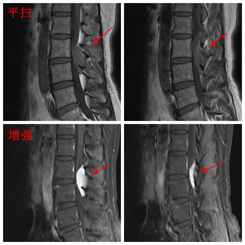 mri7269椎管内髓外占位脊膜瘤室管膜瘤