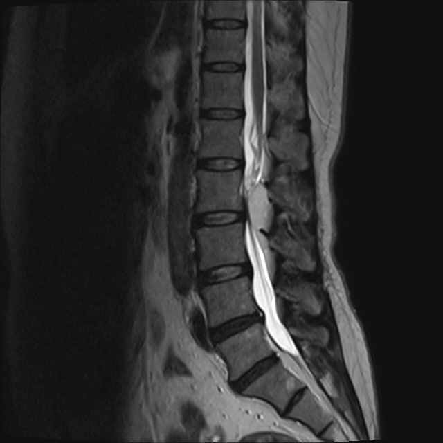 mri7269椎管内髓外占位脊膜瘤室管膜瘤