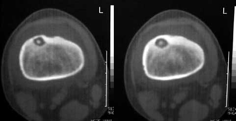 四肢ct00198股骨病变