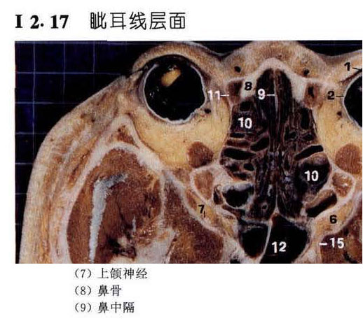 翼腭窝断层解剖