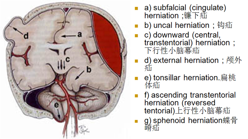脑疝图解
