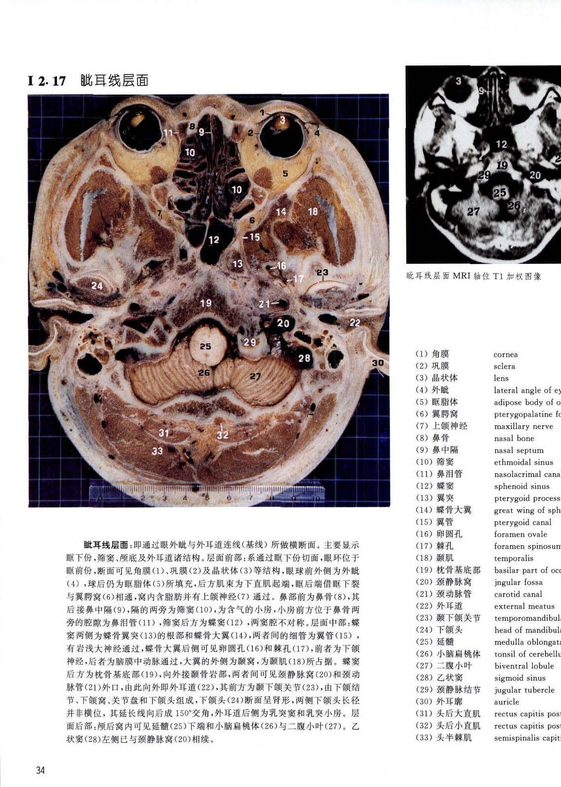 翼腭窝断层解剖