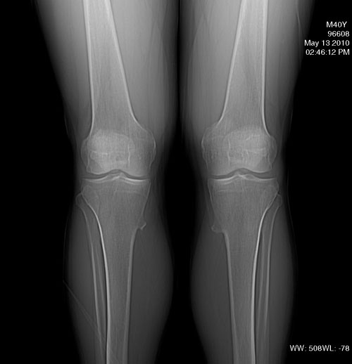 体检:左膝外侧有压痛,浮髌试验阴性,左胫骨远端有一
