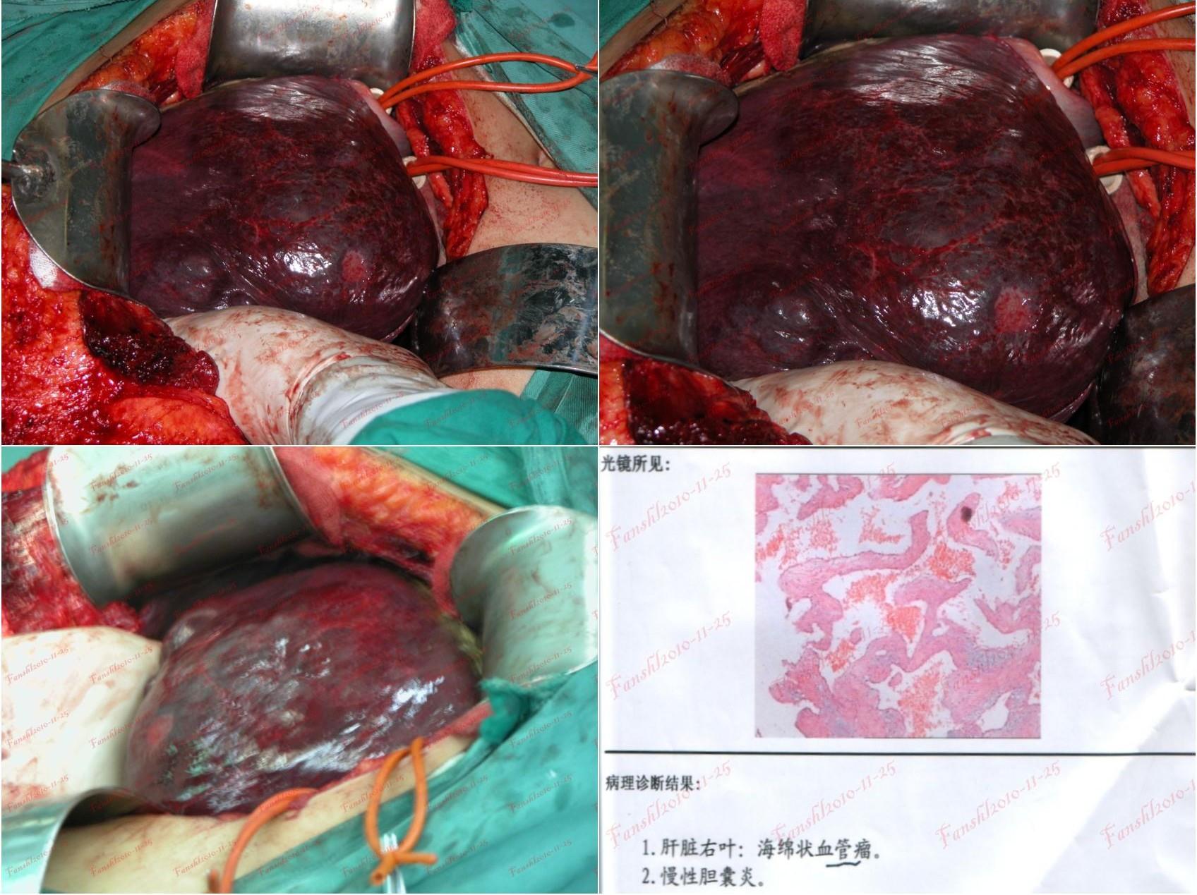 cl2466:肝脏海绵状血管瘤 典型病例(三)