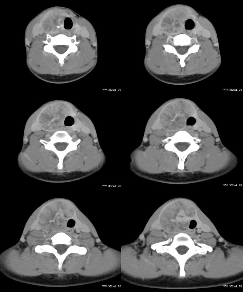 ct29888:甲状腺病变