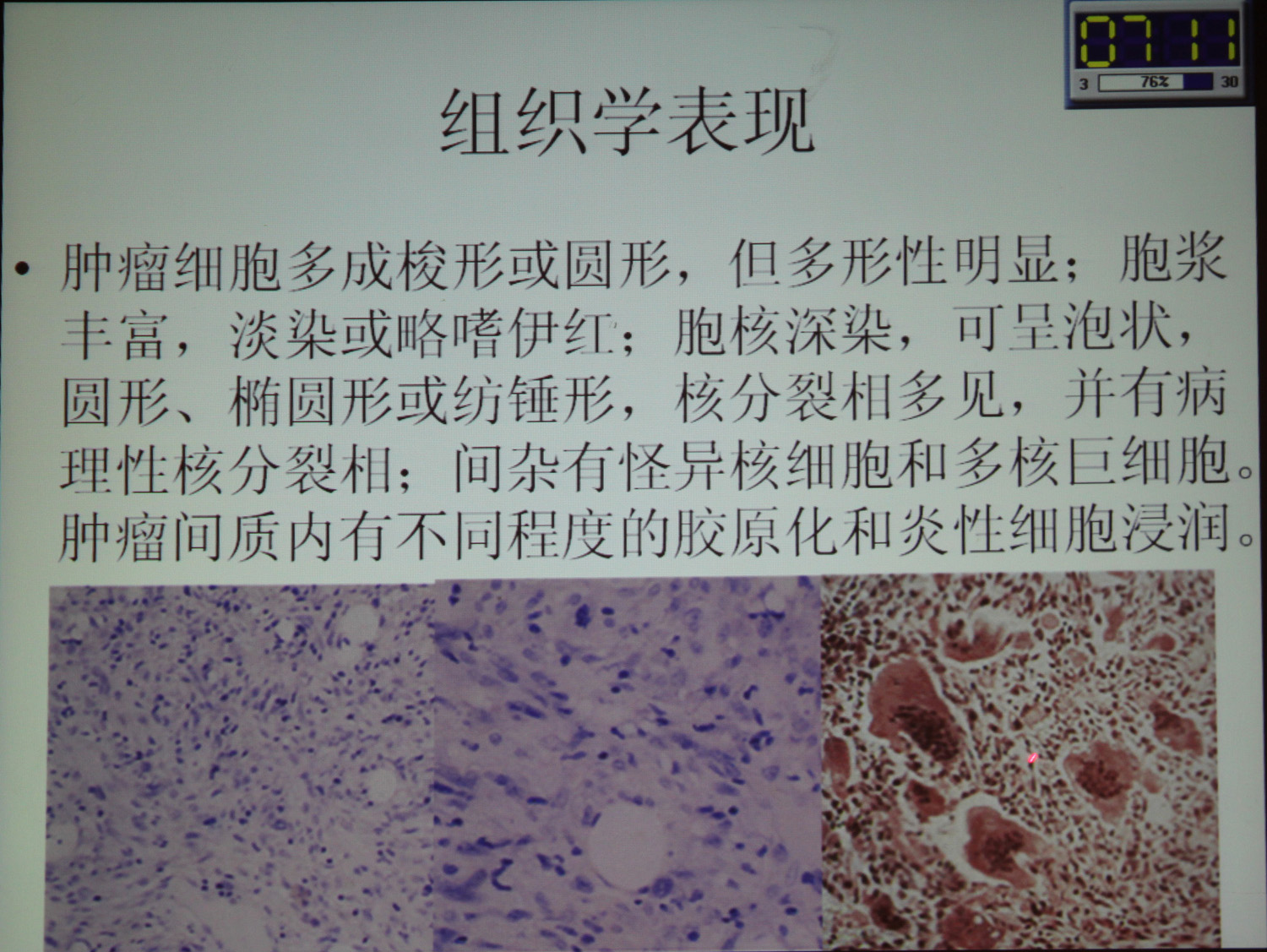 mri3384:桡骨转移性低分化腺癌