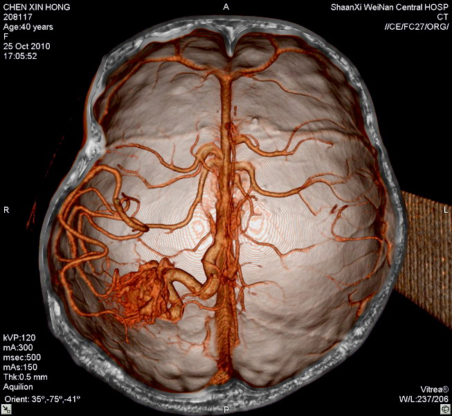 new0520:脑动静脉畸形