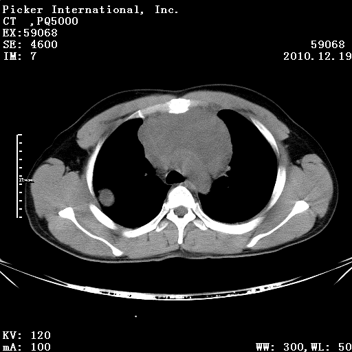 mod=viewthread&tid=74665】  三月前发现纵膈肿瘤,12-19日双肺出现